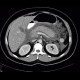 Acute pancreatitis, chylous pancreatitis, hypertriglyceridemia-associated acute pancreatitis: CT - Computed tomography